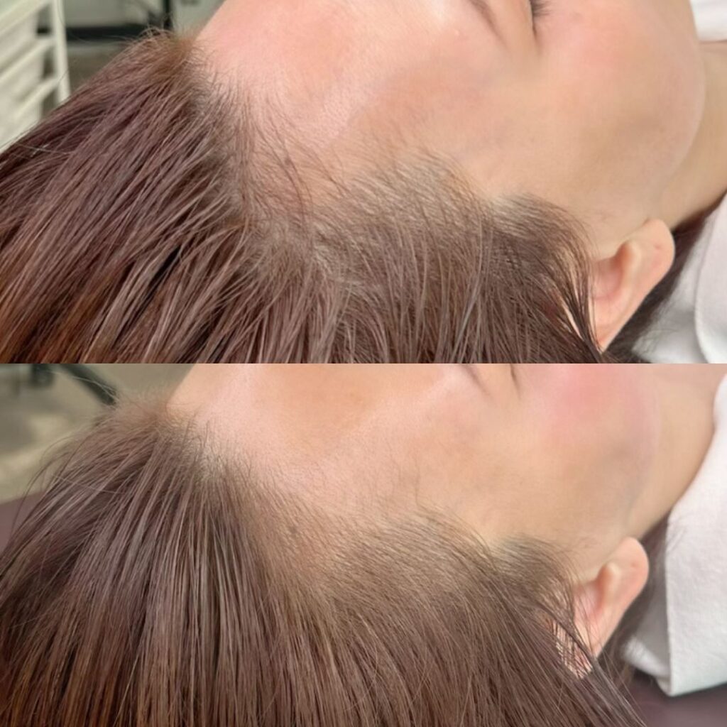 ヘアラインのアートメイクの症例写真