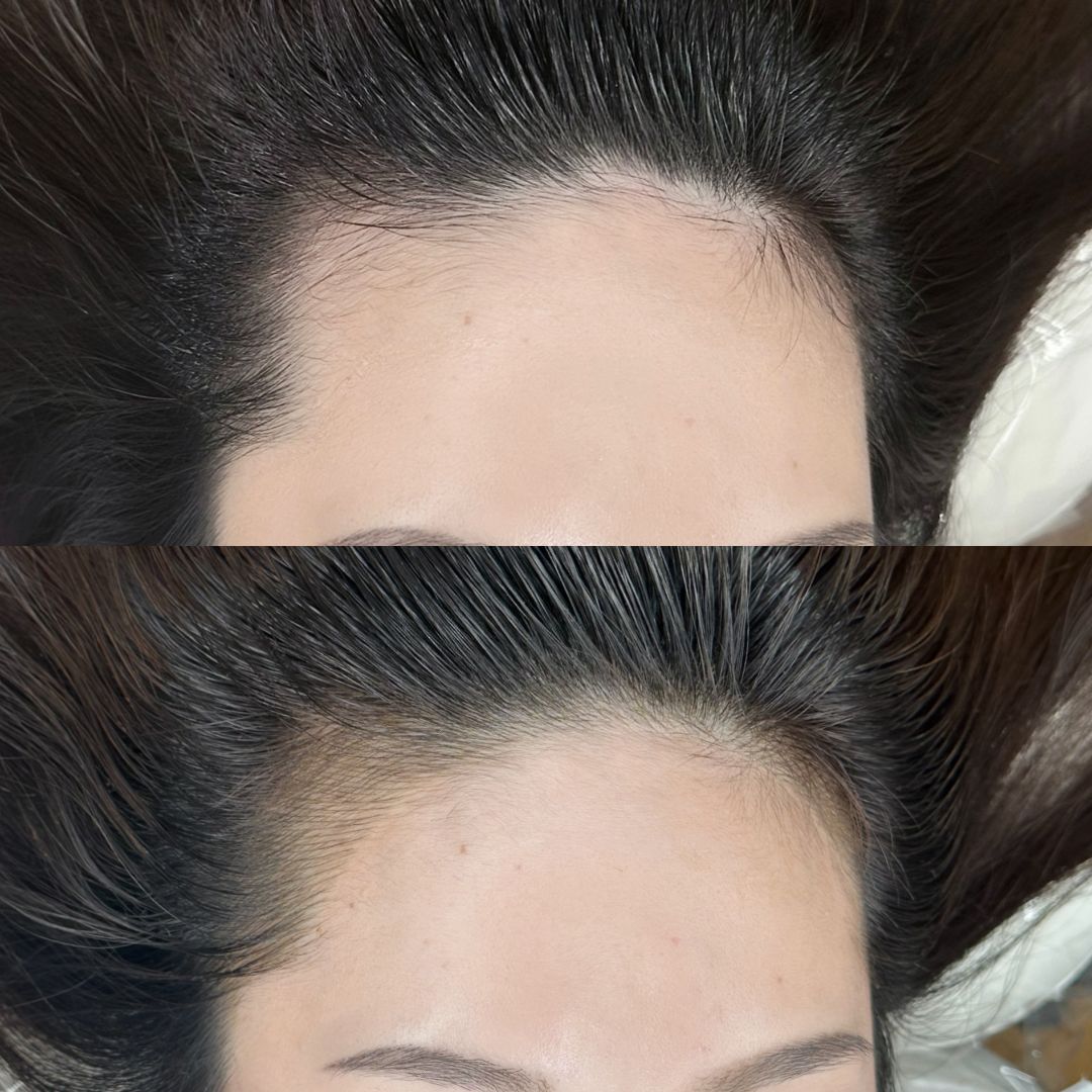 ヘアラインのアートメイクの症例写真